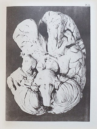 Recherches cliniques et thérapeutiques sur l'épilepsie, l'hystérie et l'idiotie, Compte rendu du service des enfants idiots, épileptiques et et arriérés de Bicêtre pendant l'année 1891 avec la collaboration de Banzet, Finet, Isch-Wall, Raoult, A. Sorel & P. Sollier.