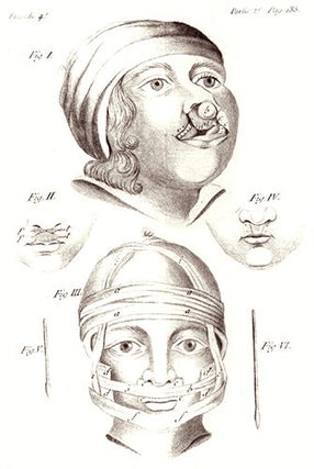 Oeuvres chirurgicales, ou exposé de la doctrine et de le pratique... I maladies des parties dures, II maladies des parties molles, III maladies des voies urinaires... par Xav. Bichat, son élève... Nelle édit. augmentée.