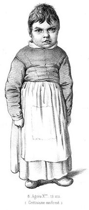 Traité des dégénérescences physiques, intellectuelles et morales de l'espèce humaine, et des causes qui produisent ces variétés maladives.