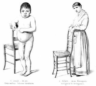 Traité des dégénérescences physiques, intellectuelles et morales de l'espèce humaine, et des causes qui produisent ces variétés maladives.