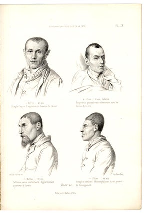 Traité des dégénérescences physiques, intellectuelles et morales de l'espèce humaine, et des causes qui produisent ces variétés maladives.